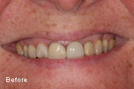 Dental Crowns Before After Pictures